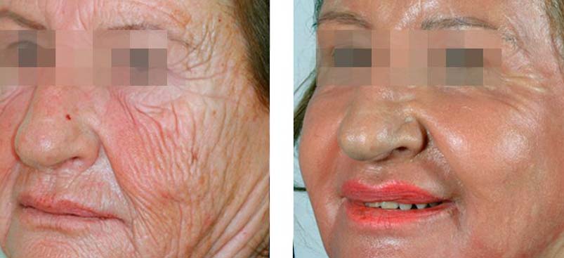 Φαινόλη Croton Oil Peel στην Αλβανία | Αναζωογόνηση προσώπου
