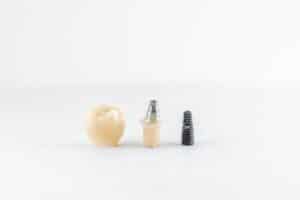 Imagen que ilustra los implantes dentales en Albania