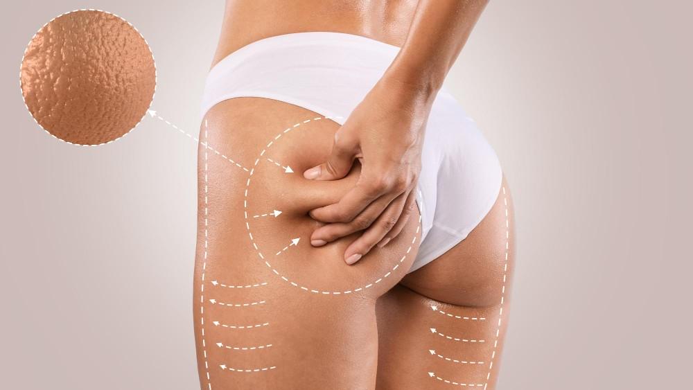 Woman's thigh with skin tightening and cellulite reduction after thigh lift surgery.