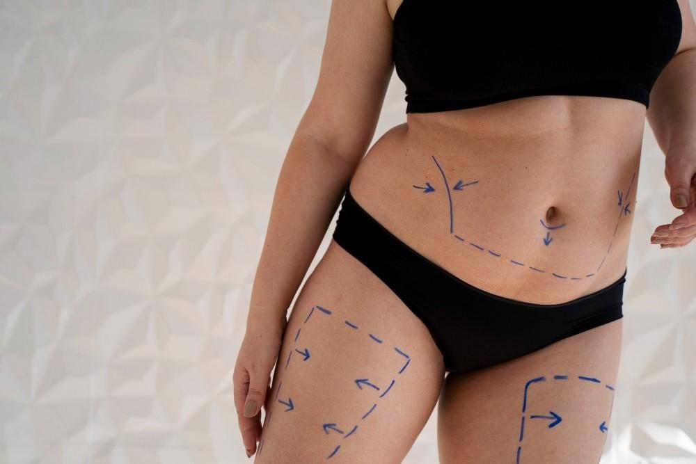Extra stomach and thigh fat which can easily be removed with a liposuction procedure