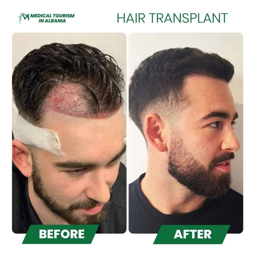 Prima e dopo trapianto di capelli in Albania con miglioramento della densità capillare.