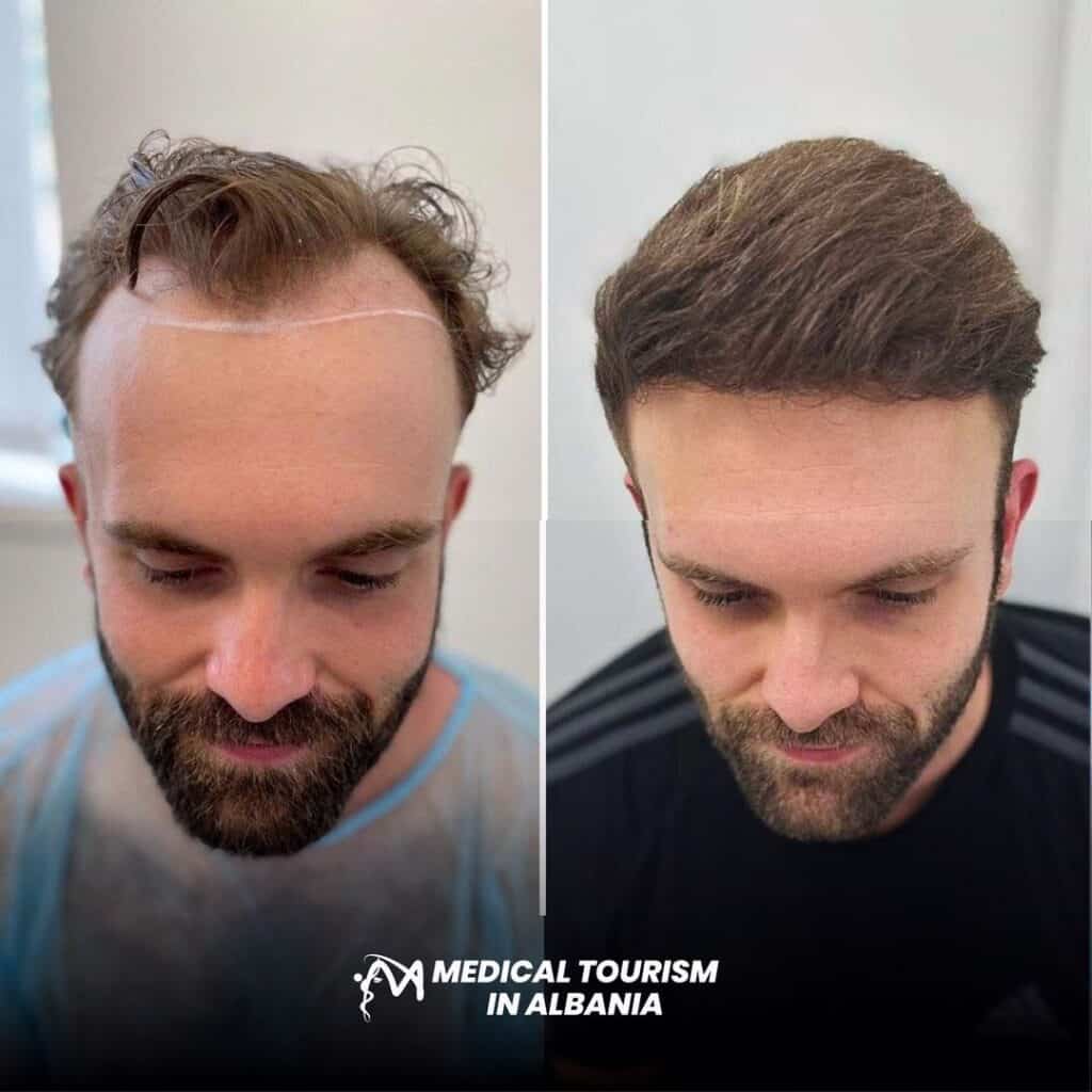 Risultati di trapianto di capelli maschile prima e dopo in Albania, a dimostrazione del successo del restauro dei capelli.
