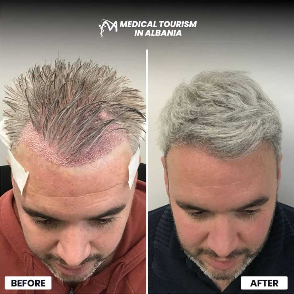 Before and after a successful hair transplant procedure in Tirana by MTA.