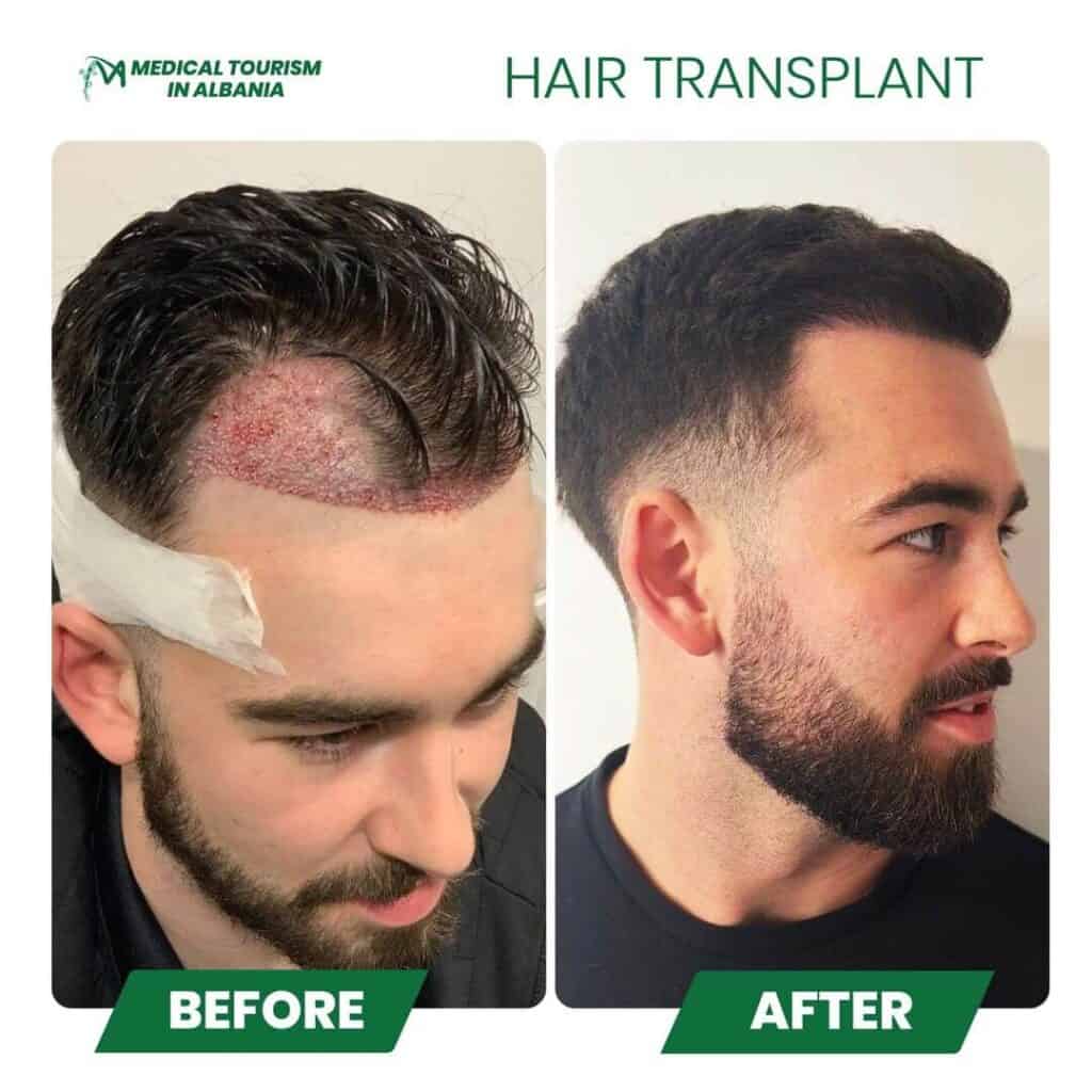 Great hair transplant results at Medical Tourism in Albania.