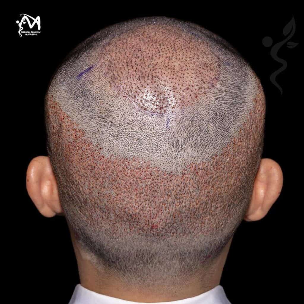 Hair after transplantation procedure is finished.