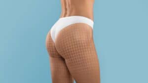 Image illustrating a butt lift surgery in Albania