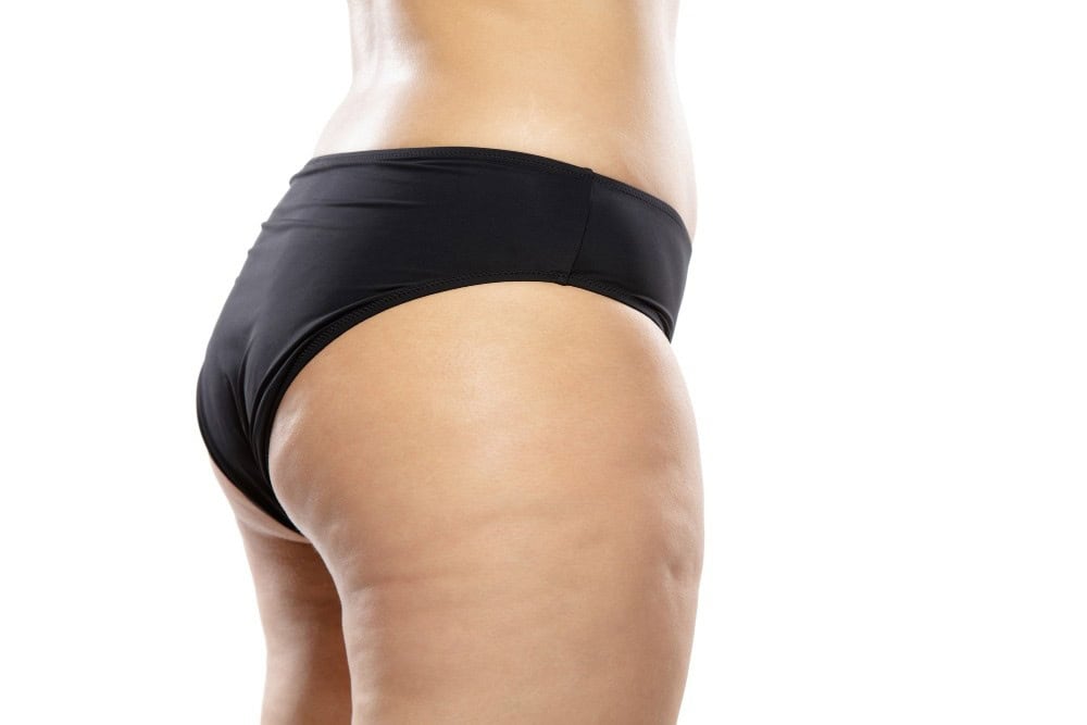Woman's buttocks after butt lift surgery in Albania for saggy bum correction.
