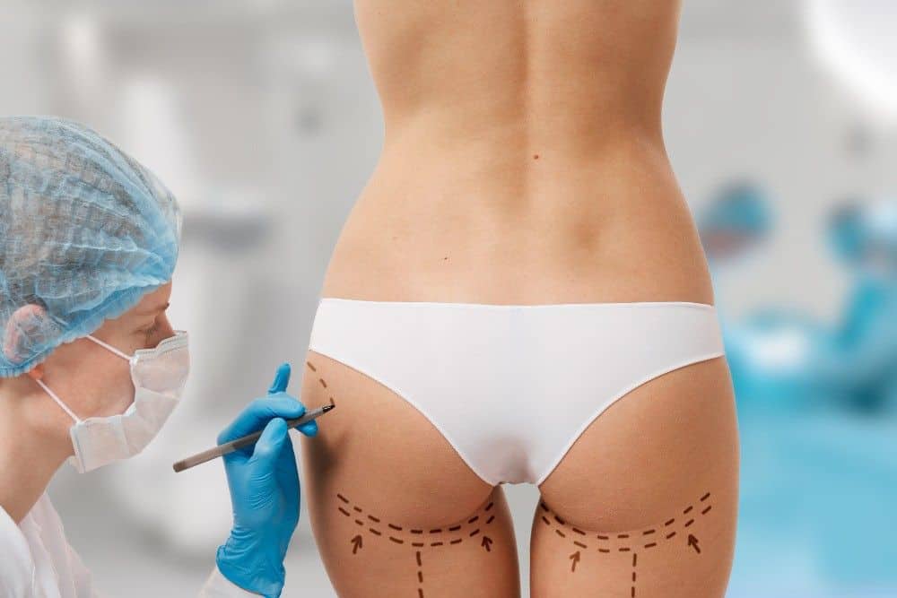 Butt lift procedure in Albania for a more youthful, toned appearance.