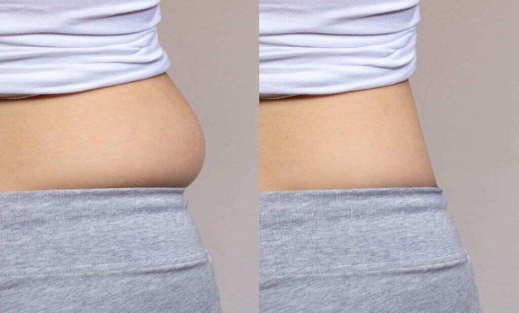 Side-by-side comparison of belly fat loss through diet, exercise, or surgery in Albania.