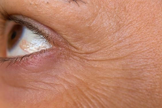 Close-up of eye showing crow's feet before chemical peel treatment.