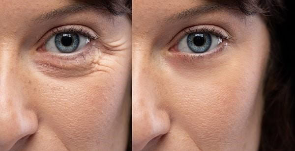 Woman's eye area before and after chemical peel for crow's feet treatment in Albania.