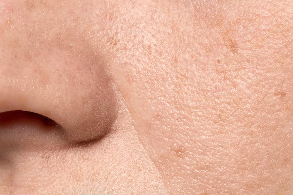 Close-up of skin showing improved texture after chemical peel for acne scars and sun damage.
