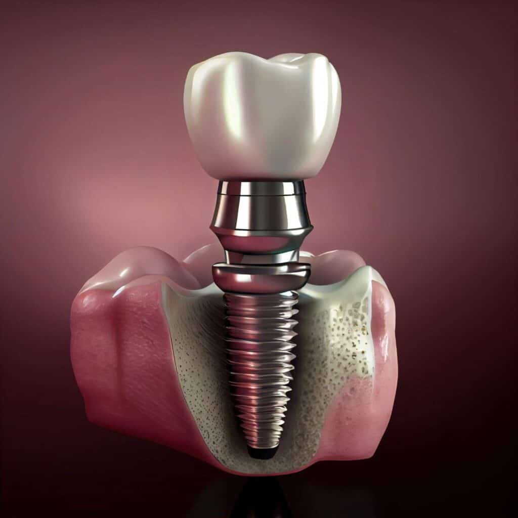 Affordable dental implants in Albania