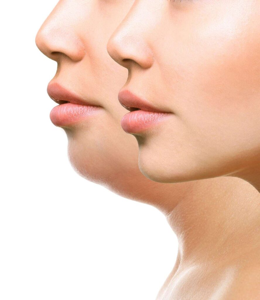 Side view of a woman's face showing smooth, youthful skin after anti-ageing procedures in Albania.