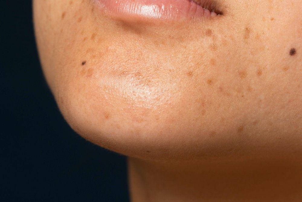 Close-up of skin showing reduced acne scars and sun damage after chemical peel.