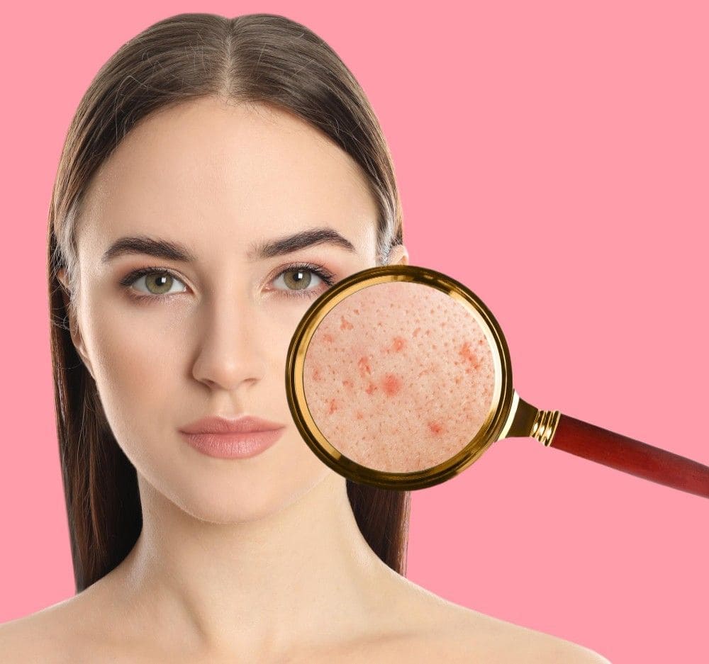 Woman with acne scars examined with magnifying glass for chemical peel treatment.
