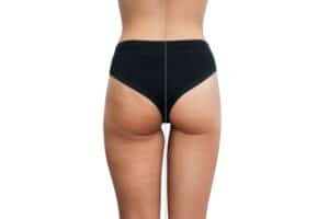 Woman's thighs showing cellulite before treatment in Albania.