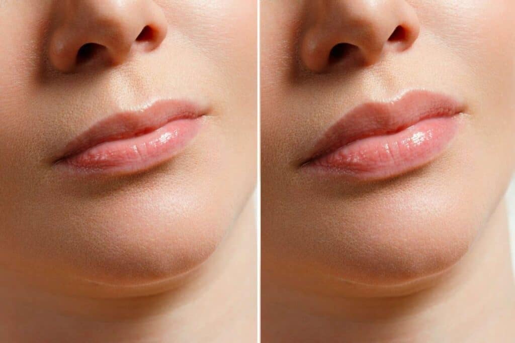 Close-up of lips before and after a lip lift procedure in Albania for cosmetic enhancement.