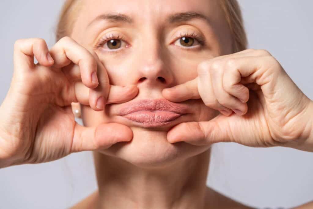 Woman pulling her lips to show a lip lift procedure, highlighting cosmetic surgery in Albania.