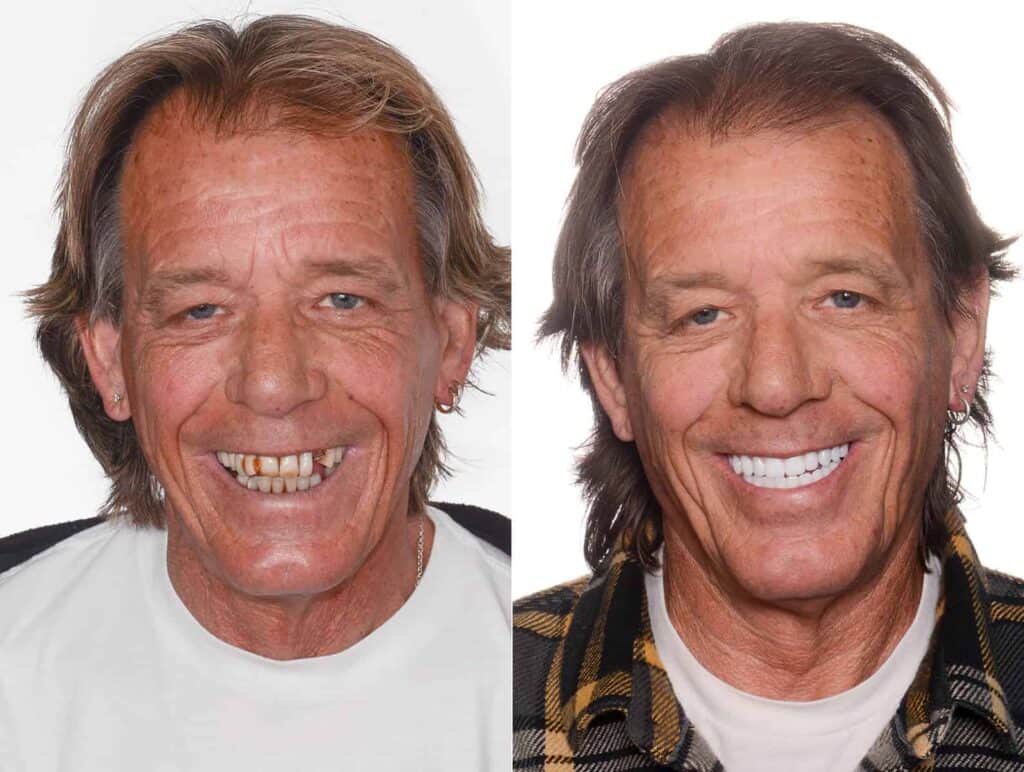 Prima e dopo gli impianti dentali in Albania, che mostrano un significativo miglioramento del sorriso.