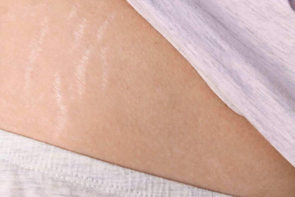 Stretch mark removal with tummy tuck surgery in Albania