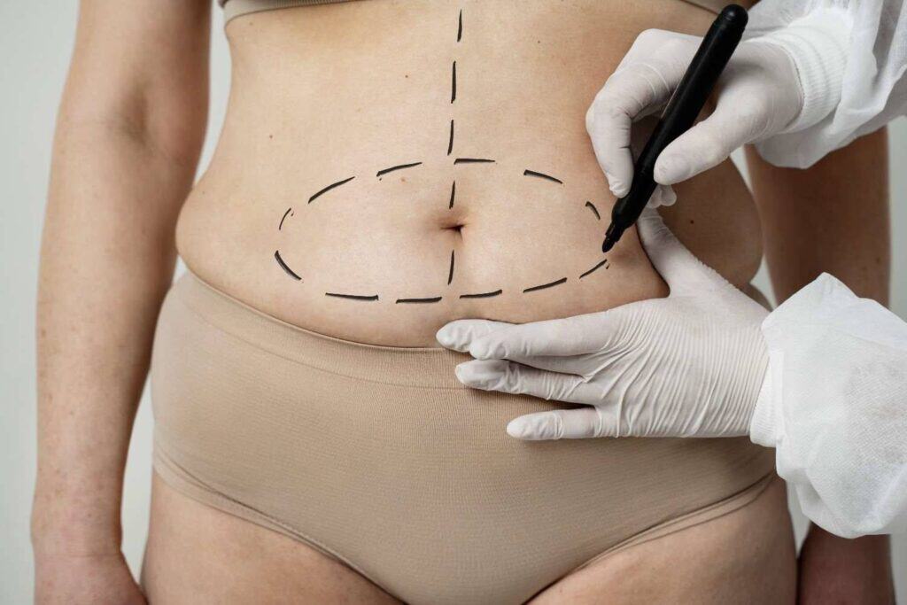 Affordable tummy tuck surgery in Albania