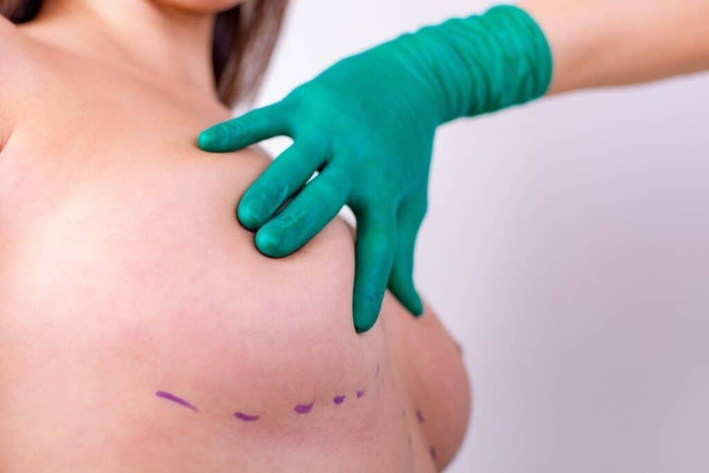 Operation zur Entfernung von Brustimplantaten in einer Klinik in Albanien