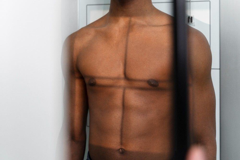 Uomo con ginecomastia prima dell'intervento in Albania, focus sulle opzioni di riduzione del seno maschile.