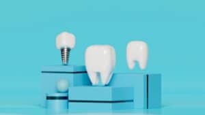 Puentes dentales frente a implantes dentales en Albania