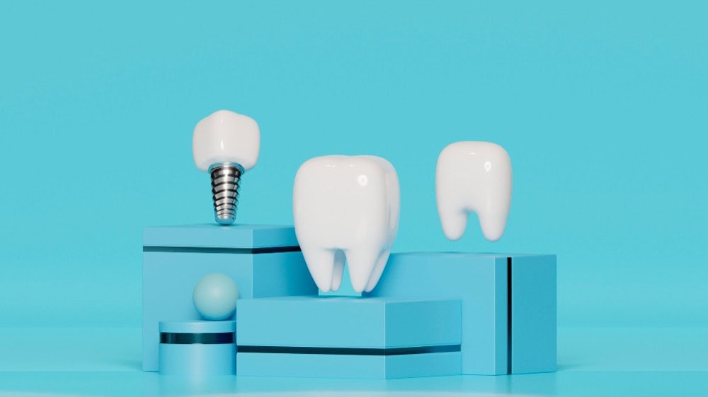 Mosty dentystyczne a implanty dentystyczne w Albanii