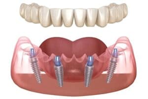 Implantes dentales all on 4 asequibles en Albania