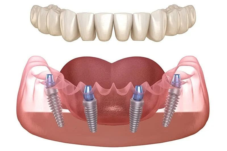 Implants dentaires à prix abordable en Albanie