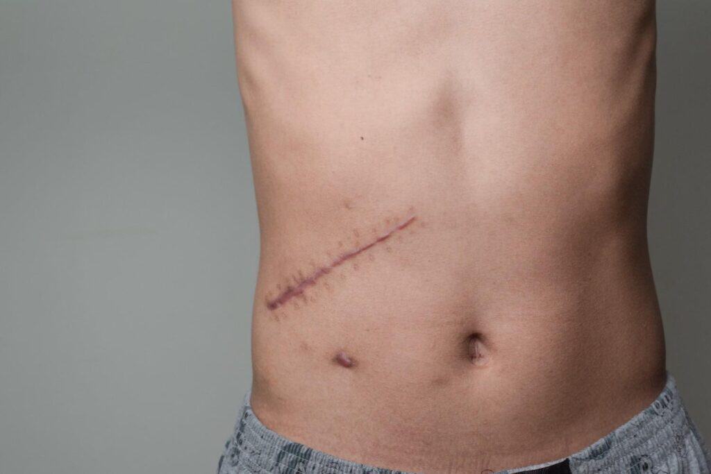 Close-up of a healed scar on a person's abdomen after revision surgery.