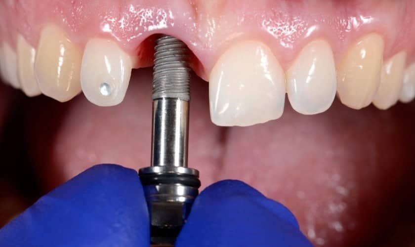 Zbliżenie implantu stomatologicznego umieszczanego w szczęce górnej w celu odbudowy całego łuku zębowego.