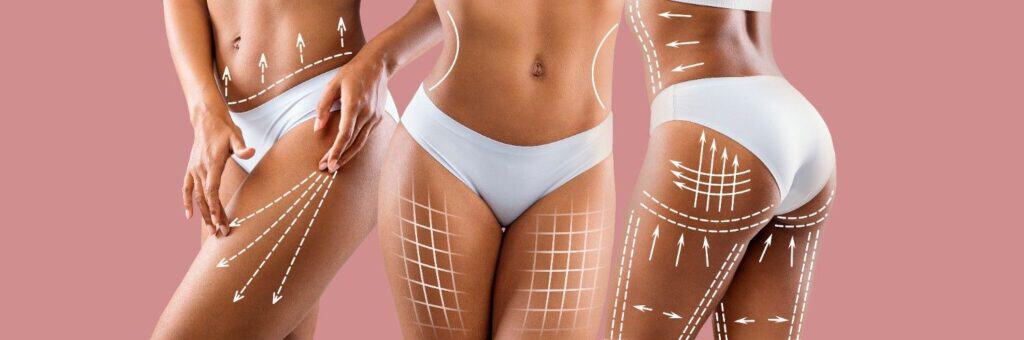 Post-motherhood body contouring in Albania for natural, aesthetic results.