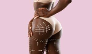 Lichaamscontouring in Albanië voor betaalbare BBL-chirurgie en veilige medische toerismeopties.