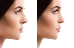 Rhinoplastiekprocedure in Albanië voor betaalbare esthetische verbetering.