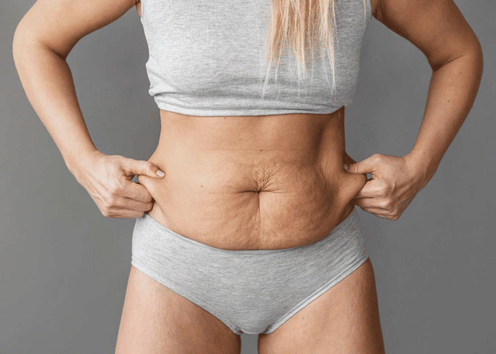 Liposuction procedure in Albania for body contouring and fat reduction. Affordable prices and qualit.