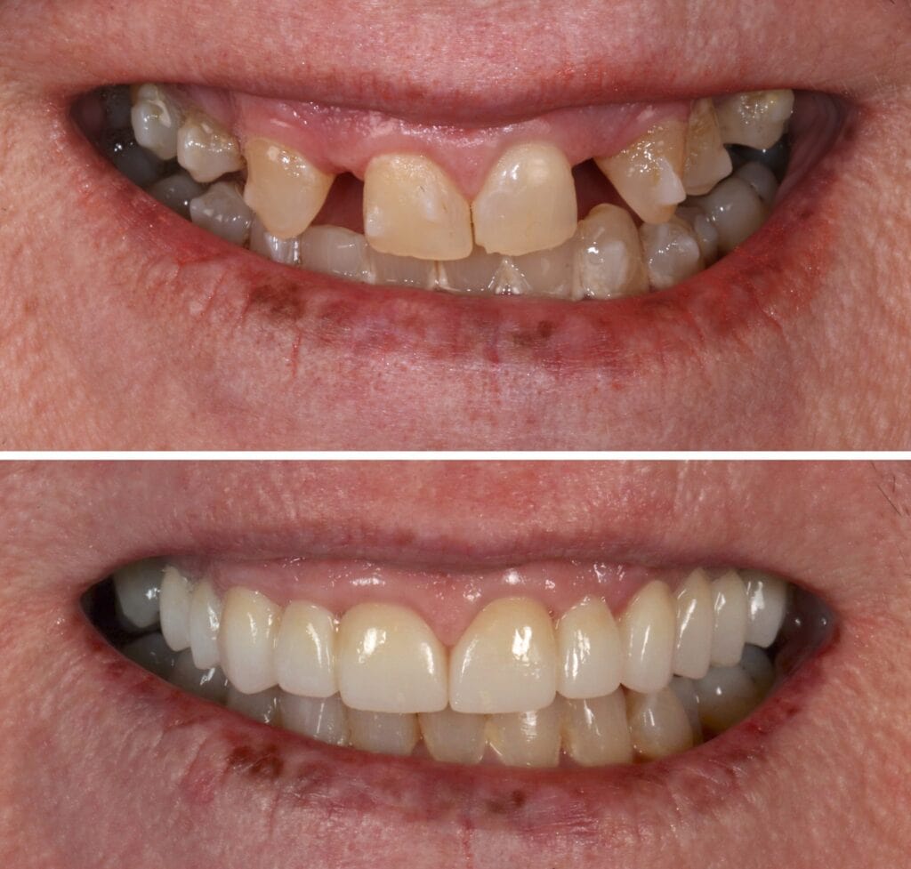 Before and after dental bridges in Albania