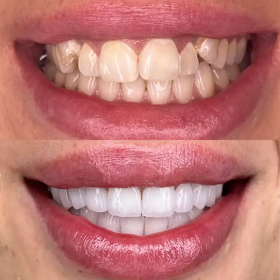 Emax Veneers στην Αλβανία