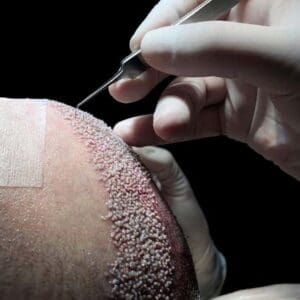 Sapphire Fue Haartransplantatie Procedure in Albanië