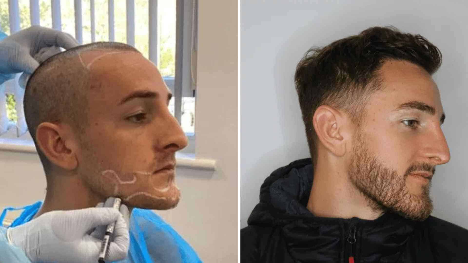 Beard Transplant Results in Albania