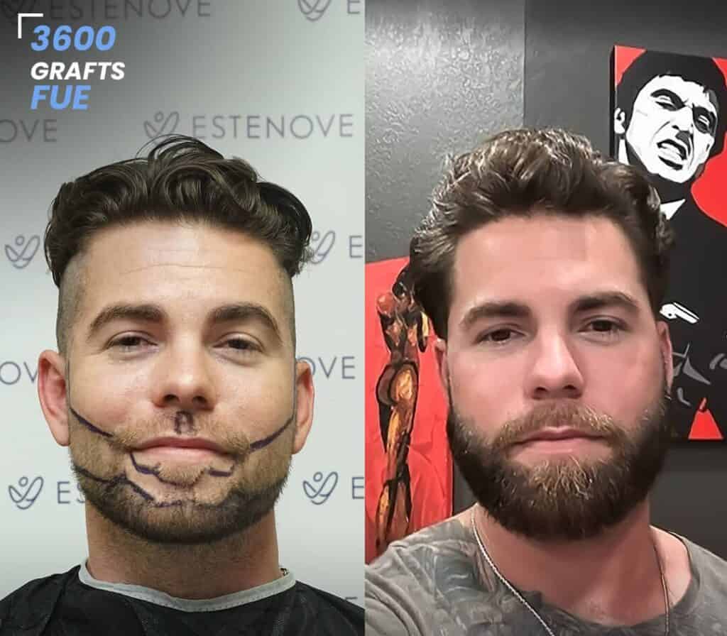 Beard Transplant in Albania