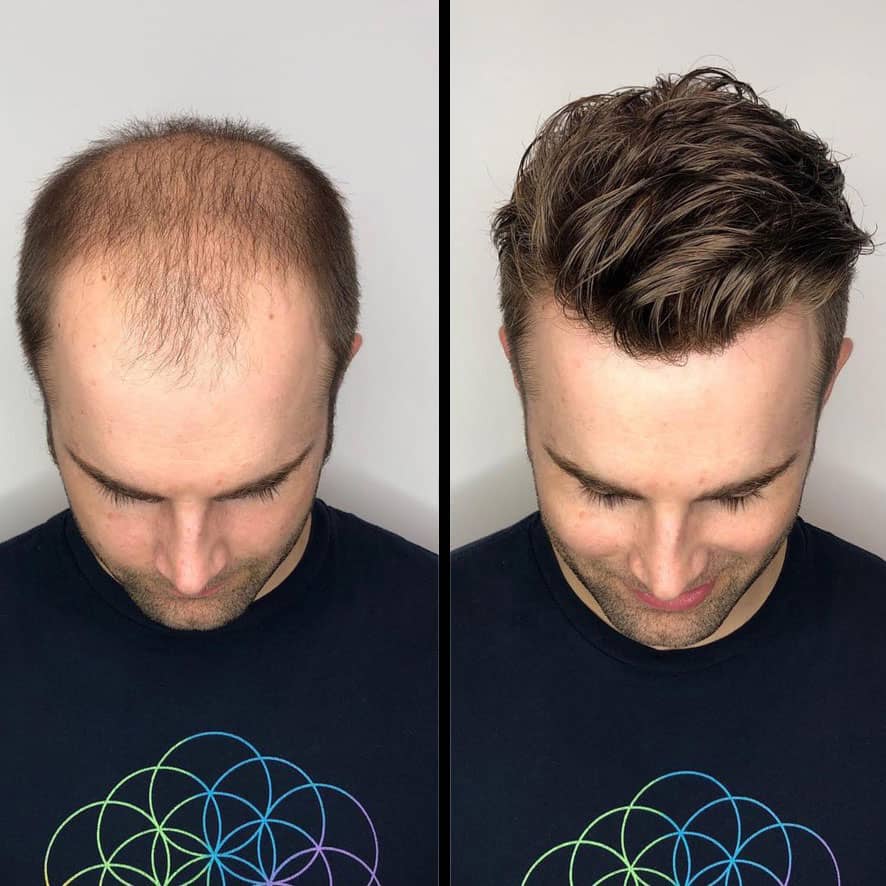 Hombres Manual Fue Trasplante de pelo en Albania Resultados 12 meses después