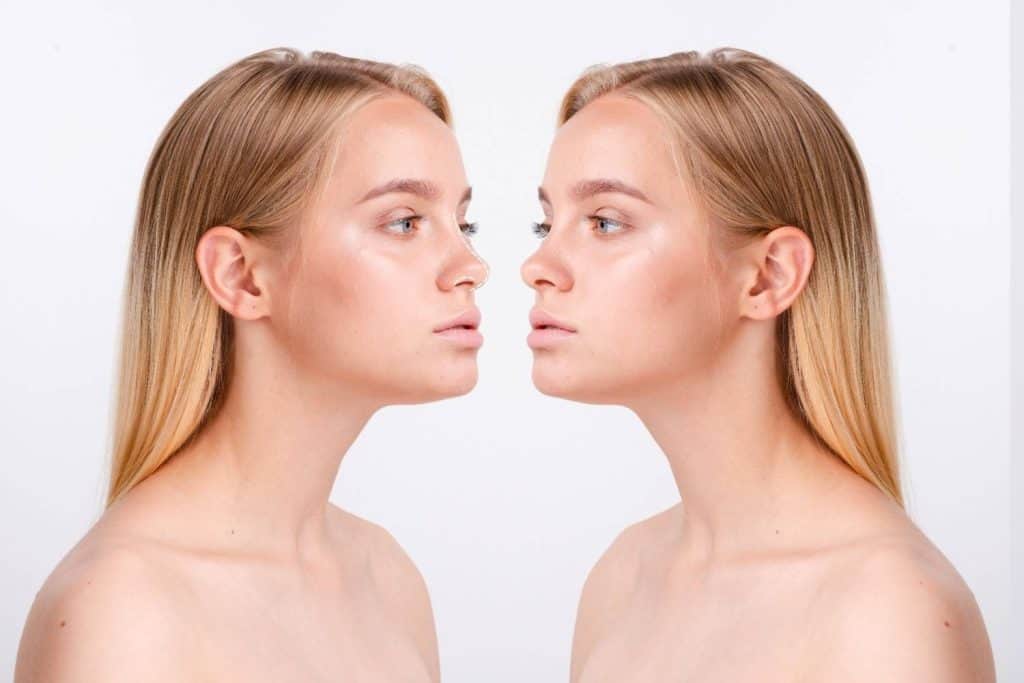 Close-up van een vrouw vóór en na een revisie-rhinoplastie met verbeterde neusvorm en symmetrie.