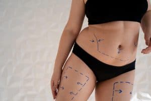 Vrouw met gemarkeerde lichaamsdelen voor liposuctie en lichaamscontouring in Albanië.