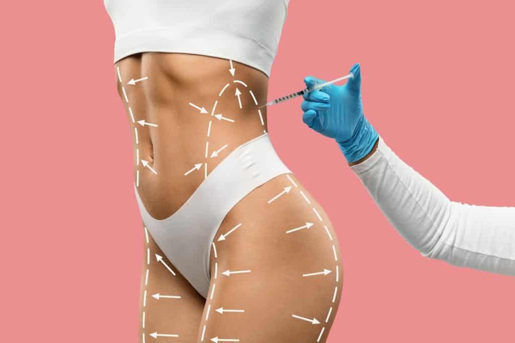 Minimaal invasieve buikwandcorrectie en liposuctieprocedure voor lichaamscontouring in Albanië.
