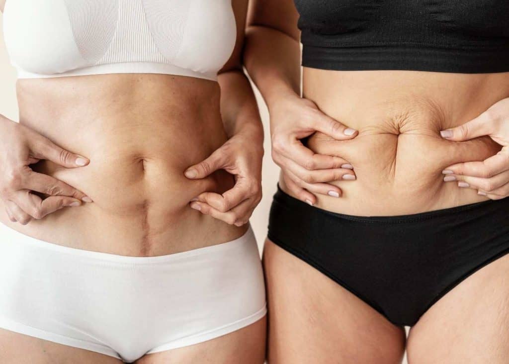 Vrouwen tonen hun buiken na een buikwandcorrectie en liposuctie in Albanië.