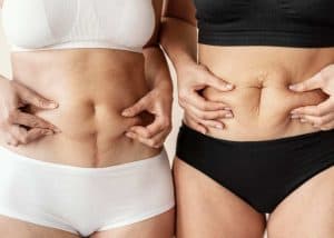Vrouwen tonen hun buiken na een buikwandcorrectie en liposuctie in Albanië.