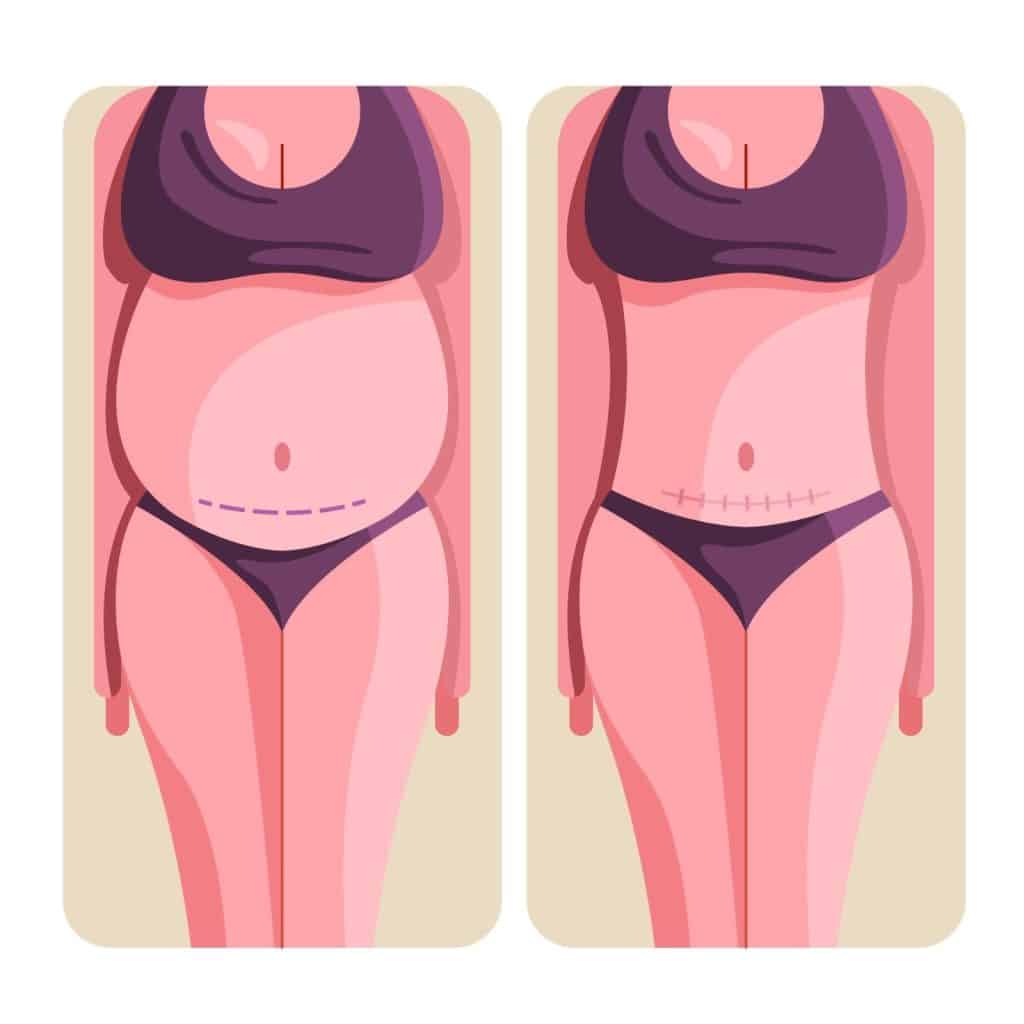 ALB Buikwandcorrectie & Liposuctie voor Lichaamsmakeover in Albanië.
